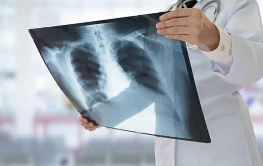 Doctor in white coat holds and examines a chest x-ray. Stethoscope visible around neck. Hospital background is blurred.